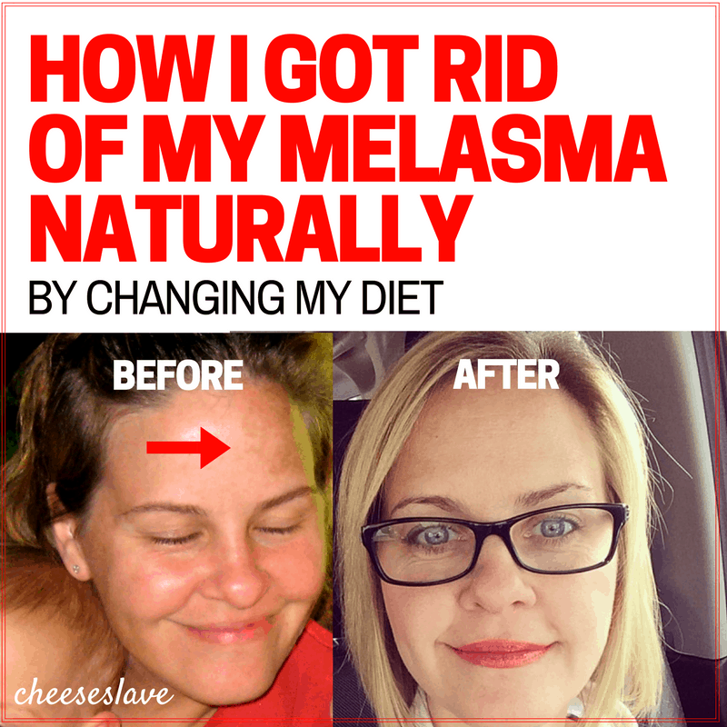 How I Got Rid of Melasma Naturally