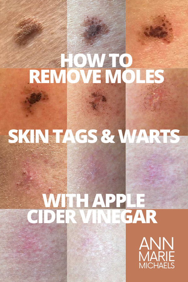 Remove Moles & Warts with Apple Cider Vinegar