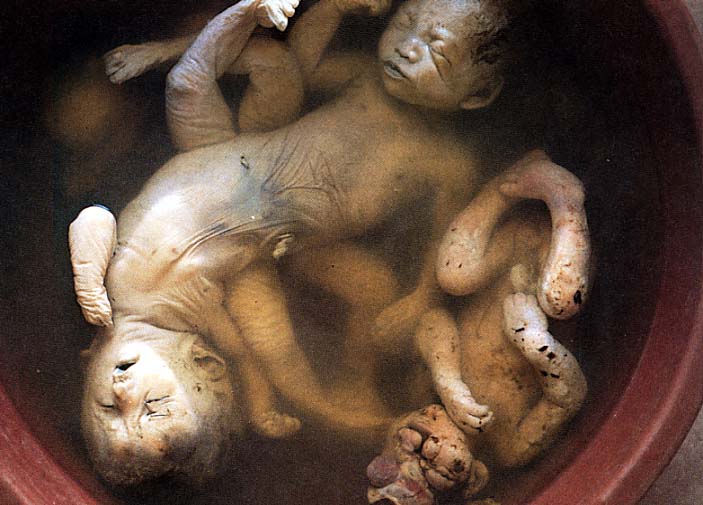 Agent Orange - stillborn deformed babies in Vietnam