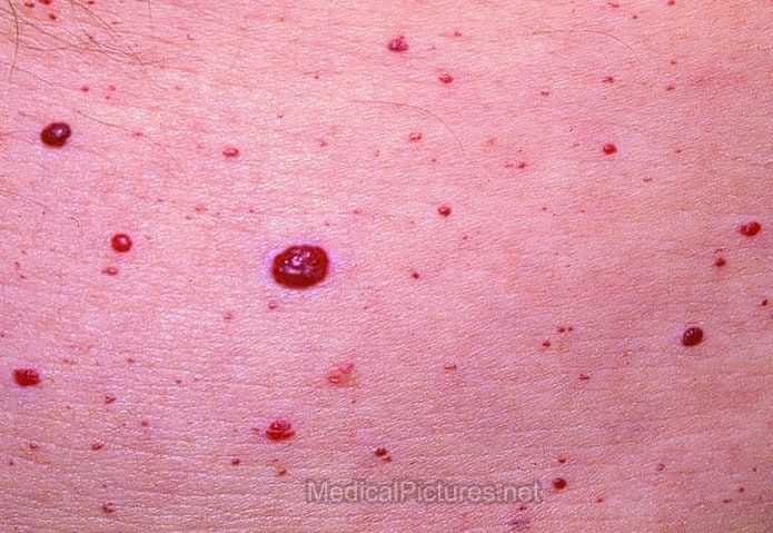 Cherry Angiomas