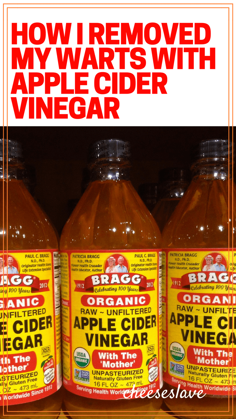 Apple Cider Vinegar for Warts: This Natural Remedy Really Works