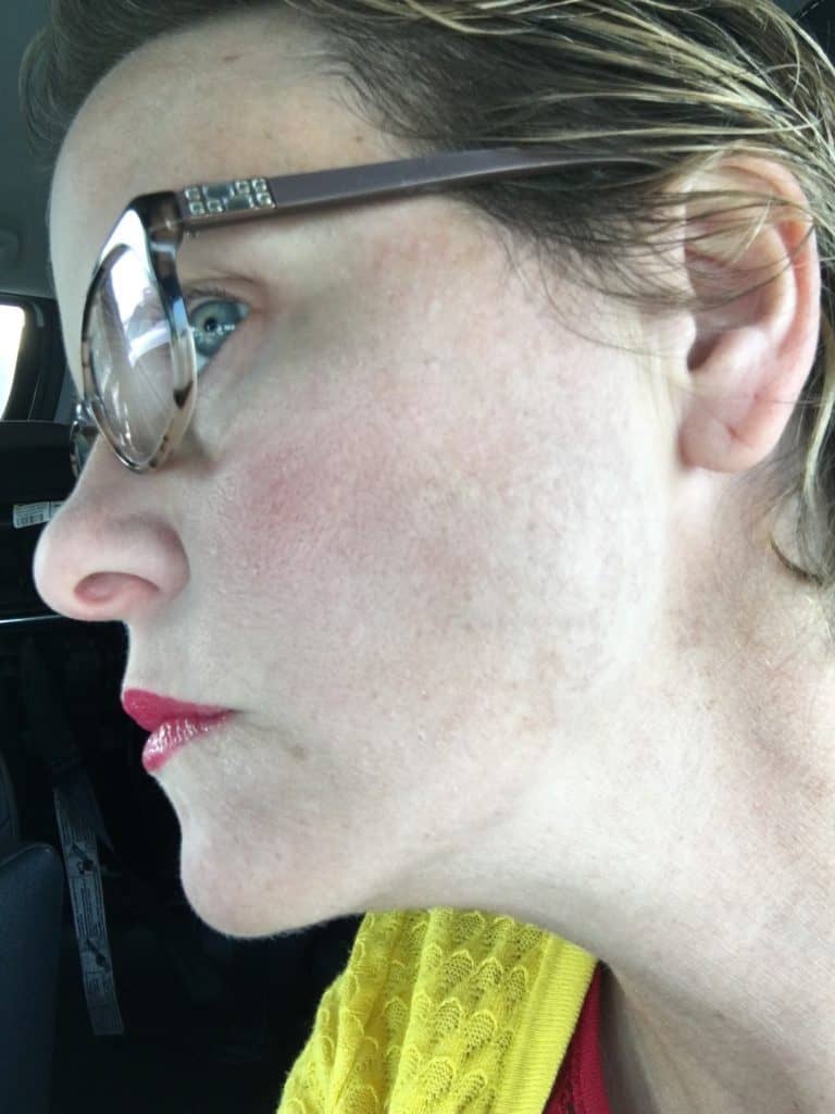 My melasma recently coming back