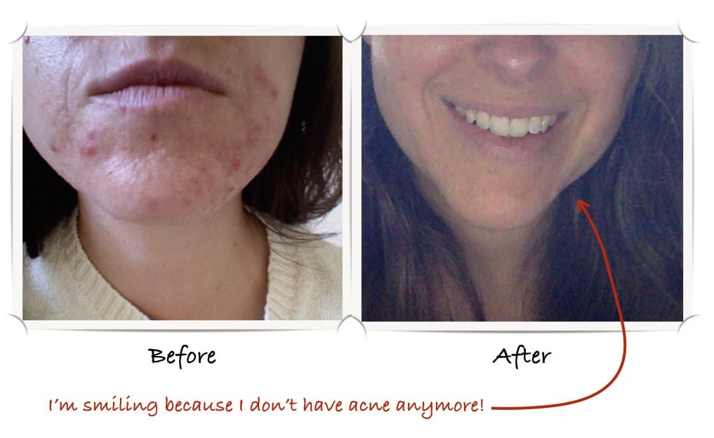 Acne: A Natural Cure Before and After