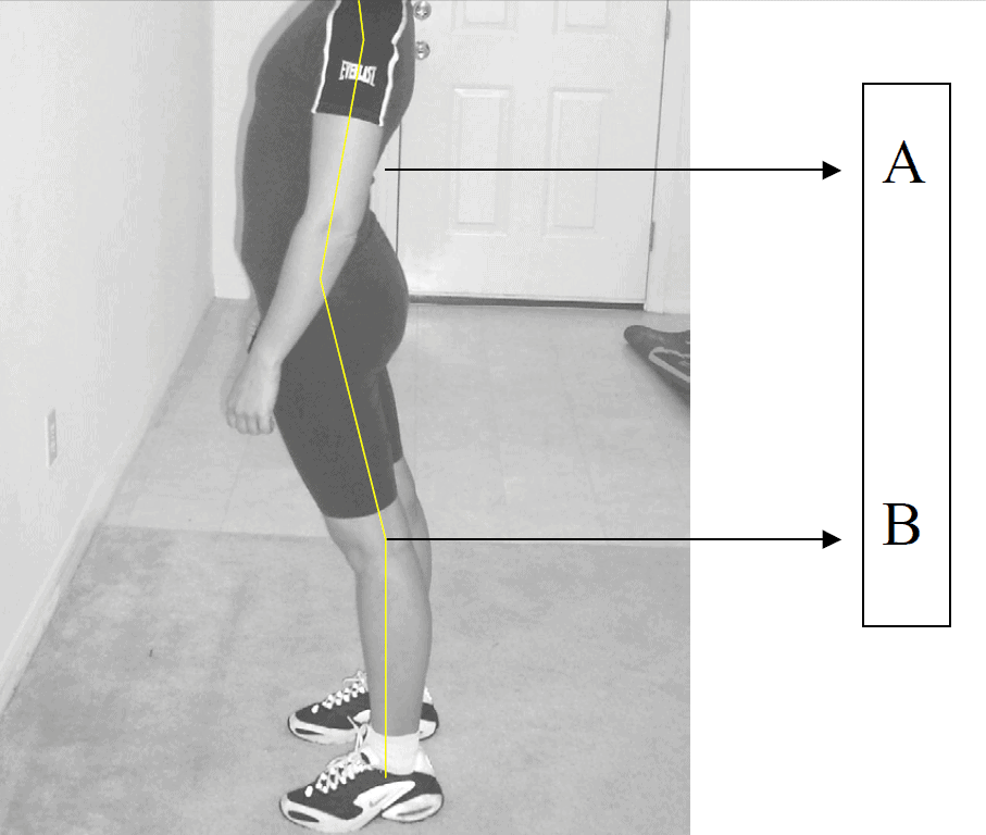 Lordosis - curvature of the spine