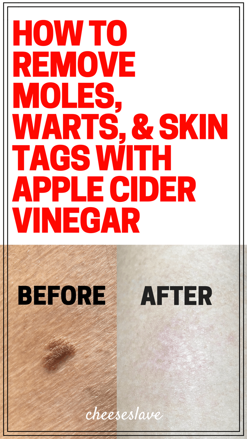 How to Remove Moles Warts and Skin Tags with Apple Cider Vinegar