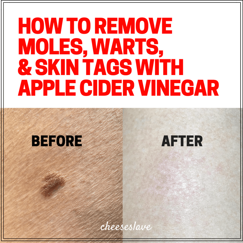 How to Remove Moles Warts and Skin Tags with Apple Cider Vinegar